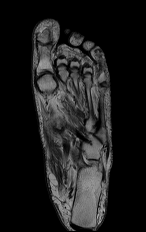 foot mri t1 coronal image mrimaster.ru